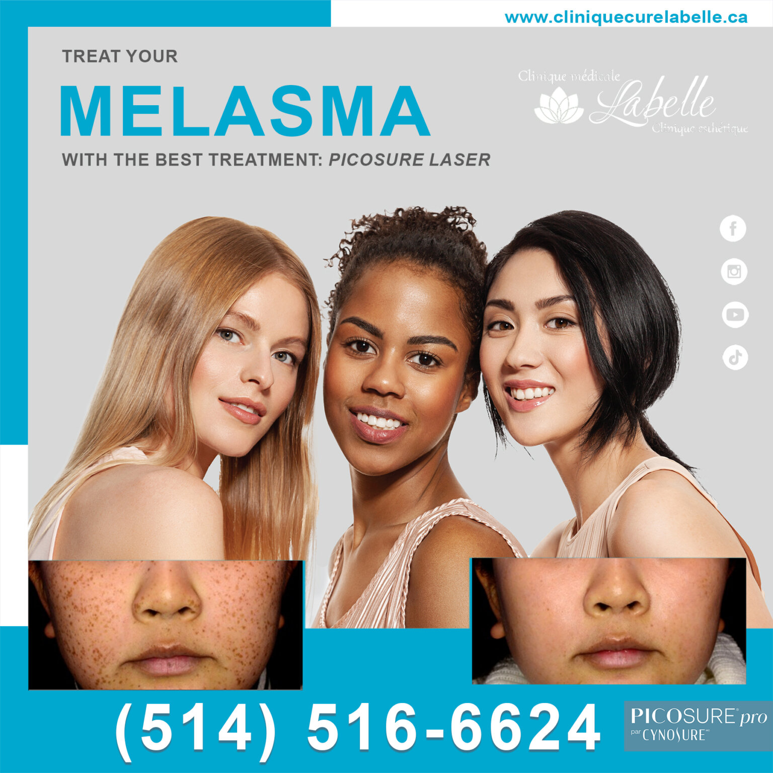 BEST TREATMENT FOR YOUR MELASMA