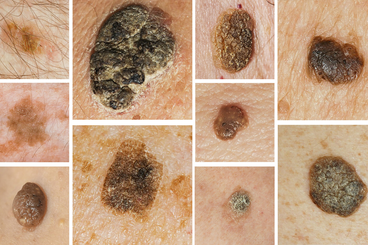 Seborrheic Keratosis Treatment in Laval and Greater Montreal Area