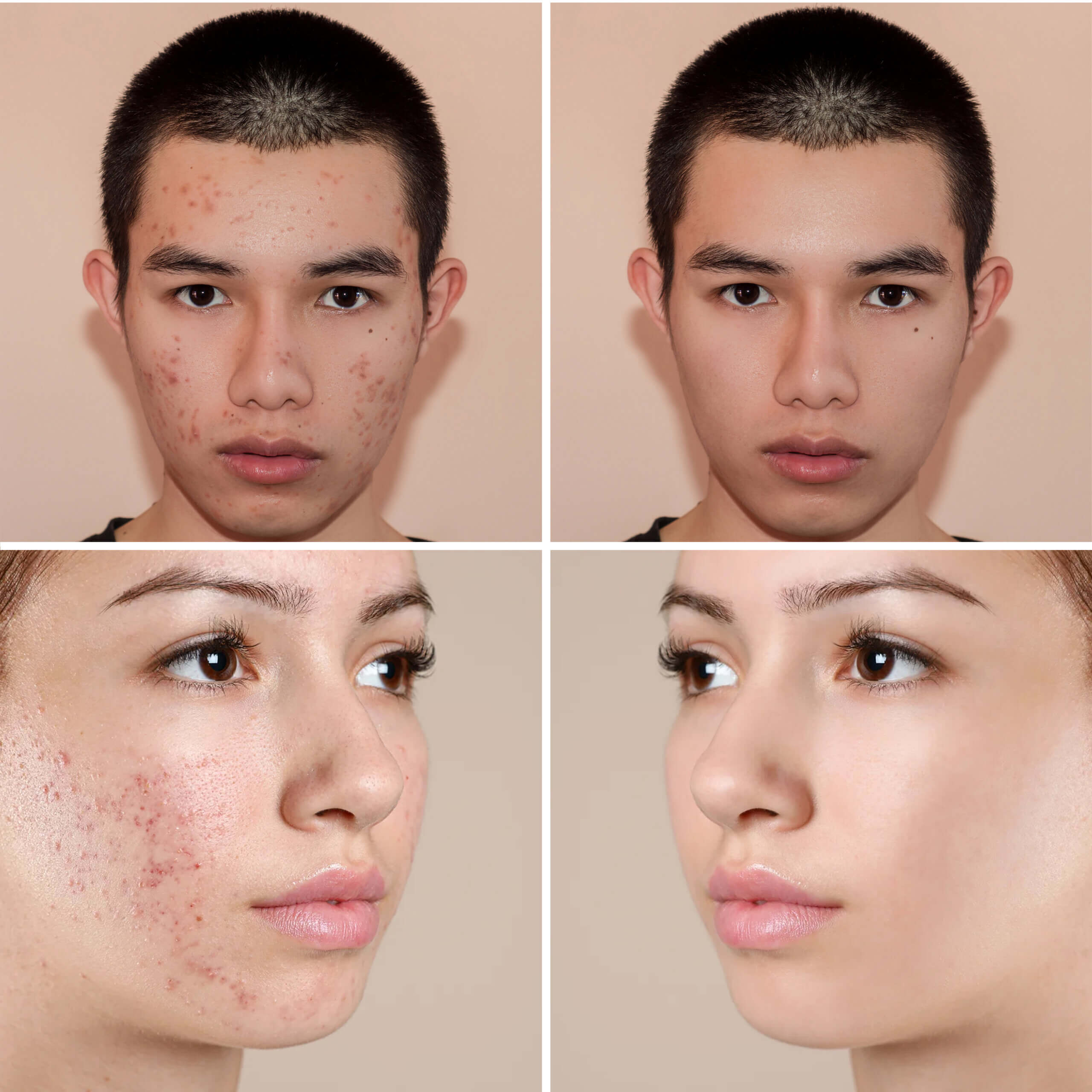 Acne Treatment from mild to severe acne in Laval and the greater Montreal area-Pimples-Papules-Blackheads-Whiteheads-Nodules-Cysts-development of acne-acne formation