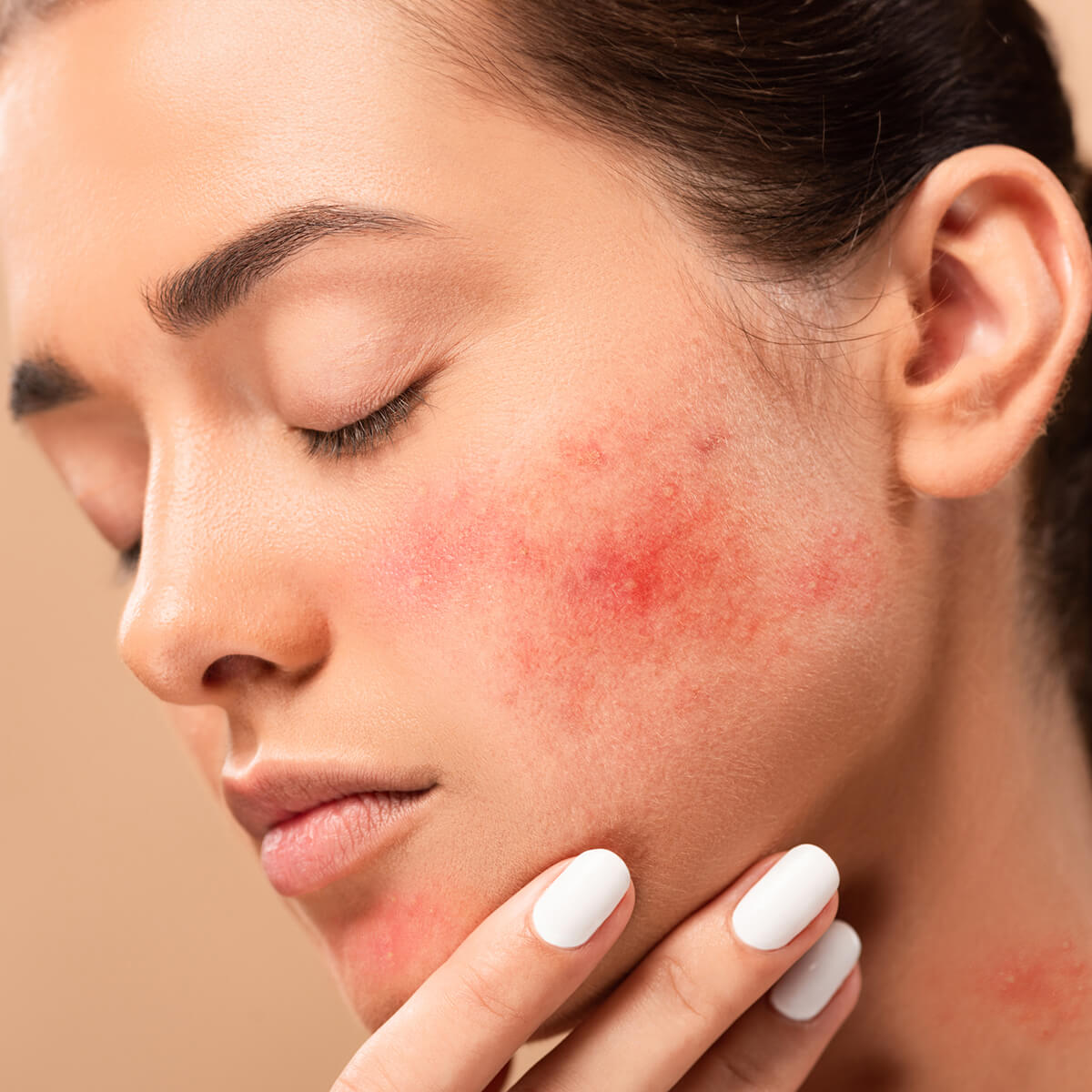 Factors and causes that contribute to the development of acne-Mild Acne-Moderate Acne-Severe Acne-Very Severe Acne-treating acne-Medications for the treatment of acne