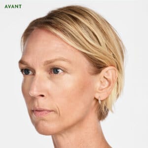Sculptra est un traitement esthétique injectable à Laval et la région de Montréal conçu pour remplir des zones spécifiques du corpss. Il favorise la production de collagène naturel dans votre corps, permettant de combler les rides sur le long terme et d'aider votre peau à générer du nouveau collagène.