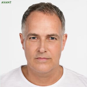 Rajeunissement avec Radiesse. Cinq raisons pour lesquelles vous pourriez envisager d'utiliser l’injections Radiesse
