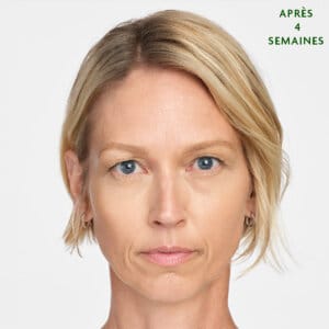 Sculptra est un traitement esthétique injectable à Laval et la région de Montréal conçu pour remplir des zones spécifiques du corpss. Il favorise la production de collagène naturel dans votre corps, permettant de combler les rides sur le long terme et d'aider votre peau à générer du nouveau collagène.