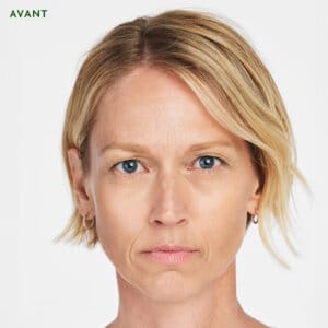 Sculptra est un traitement esthétique injectable à Laval et la région de Montréal conçu pour remplir des zones spécifiques du corpss. Il favorise la production de collagène naturel dans votre corps, permettant de combler les rides sur le long terme et d'aider votre peau à générer du nouveau collagène.
