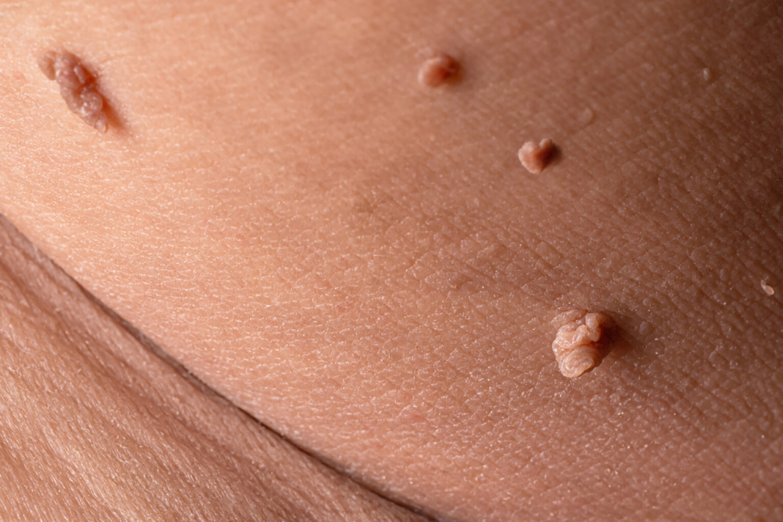 How are skin tags diagnosed-skin tags biopsy-skin tags and medical evaluation-skin tags and consultation-consultation skin tags-skin tags irritation