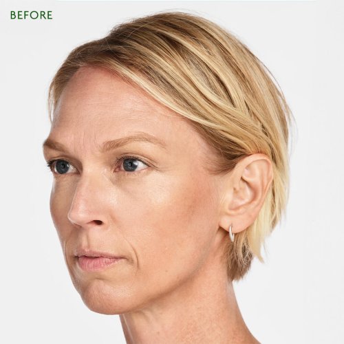 Volume and Contours. Radiesse is ideal for restoring lost volume and improving facial contours, particularly in the cheeks, jawline and chin. Deep Wrinkles and Folds It is effective in reducing deep wrinkles and folds, such as nasolabial folds (smile lines) and marionette lines. Collagen Stimulation Radiesse stimulates collagen production, which gradually improves skin texture and firmness.